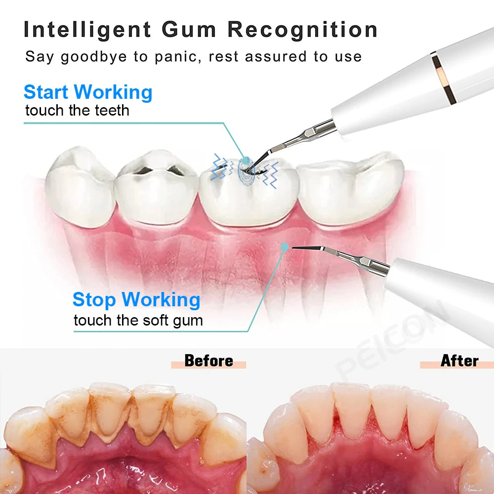 Ultrasonic Dental Teeth Plaque Remover &amp; Cleaner