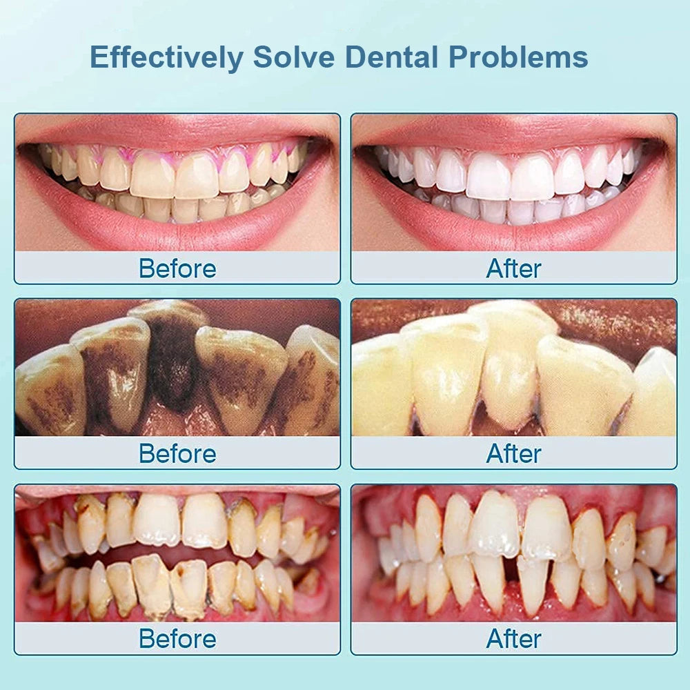Ultrasonic Dental Teeth Plaque Remover &amp; Cleaner