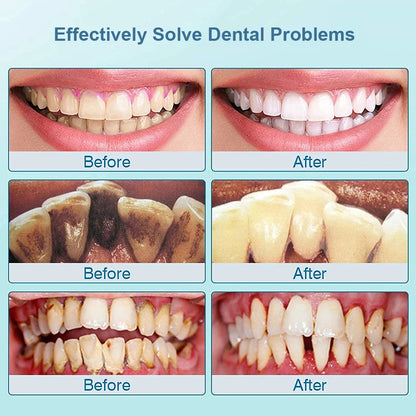 Ultrasonic Dental Teeth Plaque Remover &amp; Cleaner