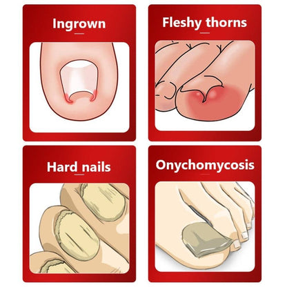 Toe Nail Clippers Nail Correction Thick Nails Ingrown Toenails Nippers