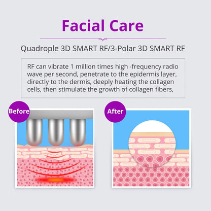 Cavitation Machine for Body Slimming/Skin Tightening